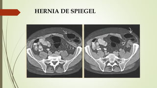 HERNIA DE SPIEGEL
 