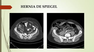 HERNIA DE SPIEGEL
 