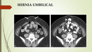 HERNIA UMBILICAL
 