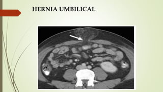 HERNIA UMBILICAL
 