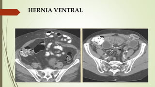 HERNIA VENTRAL
 