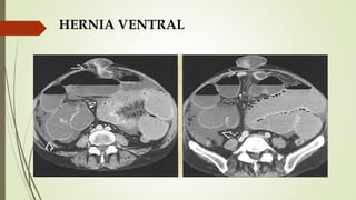 HERNIA VENTRAL
 