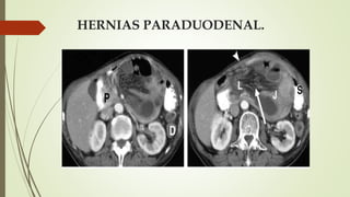 HERNIAS PARADUODENAL.
 