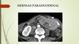 HERNIAS PARADUODENAL
 