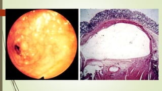 Microscópicamente
PRIMARIA
 Múltiples quistes de pared fina llenos
de gas y no comunicados en la capa
subserosa o submucosa del intestino.
 Muscular y mucosa normales.
SECUNDARIA
 Líneas prominentes de gas paralelas
a la pared intestinal.
 Características necróticas,
inflamatorias, ulcerosas o isquémicas
 