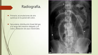 Radiografía.
 Primaria: acumulaciones de aire
quísticas en la pared del colon.
 Secundaria: distribución lineal del gas
a lo largo del intestino delgado y el
colon, dilatación de asas intestinales.
 
