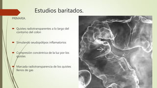 Estudios baritados.
PRIMARIA.
 Quistes radiotransparentes a lo largo del
contorno del colon
 Simulando seudopólipos inflamatorios
 Compresión concéntrica de la luz por los
quistes
 Marcada radiotransparencia de los quistes
llenos de gas
 