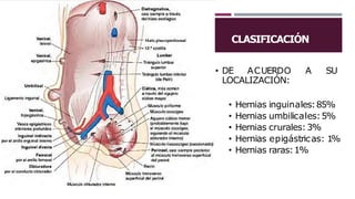 CLASIFICACIÓN
• DE ACUERDO A SU
LOCALIZACIÓN:
• Hernias inguinales:85%
• Hernias umbilicales:5%
• Hernias crurales:3%
• Hernias epigástricas: 1%
• Hernias raras:1%
 