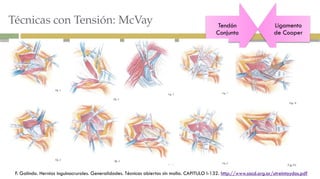 Mcvay Incision HERNIAS INGUINALES..pptx CIRUGIA GENERAL | PPTX