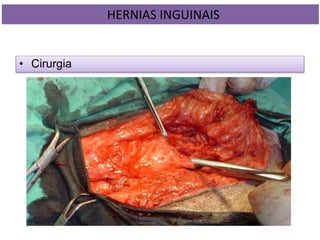 • Cirurgia
HERNIAS INGUINAIS
 