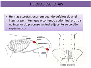 • Hérnias escrotais ocorrem quando defeitos do anel
inguinal permitem que o conteúdo abdominal protrua
no interior do processo vaginal adjacente ao cordão
espermático
Incisão cirúrgica
HERNIAS ESCROTAIS
 
