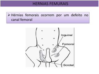  Hérnias femorais ocorrem por um defeito no
canal femoral
HERNIAS FEMURAIS
 