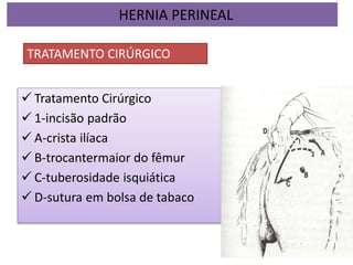  Tratamento Cirúrgico
 1-incisão padrão
 A-crista ilíaca
 B-trocantermaior do fêmur
 C-tuberosidade isquiática
 D-sutura em bolsa de tabaco
HERNIA PERINEAL
TRATAMENTO CIRÚRGICO
 
