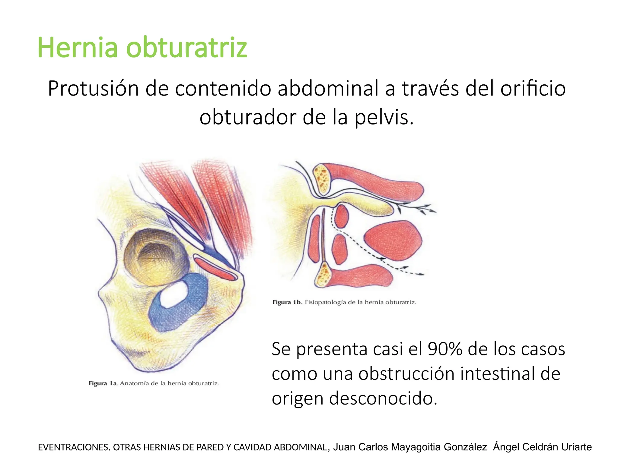 Hernia obturatriz
EVENTRACIONES. OTRAS HERNIAS DE PARED Y CAVIDAD ABDOMINAL, Juan Carlos Mayagoitia González Ángel Celdrán Uriarte
Protusión de contenido abdominal a través del orificio
obturador de la pelvis.
Se presenta casi el 90% de los casos
como una obstrucción intestinal de
origen desconocido.
 