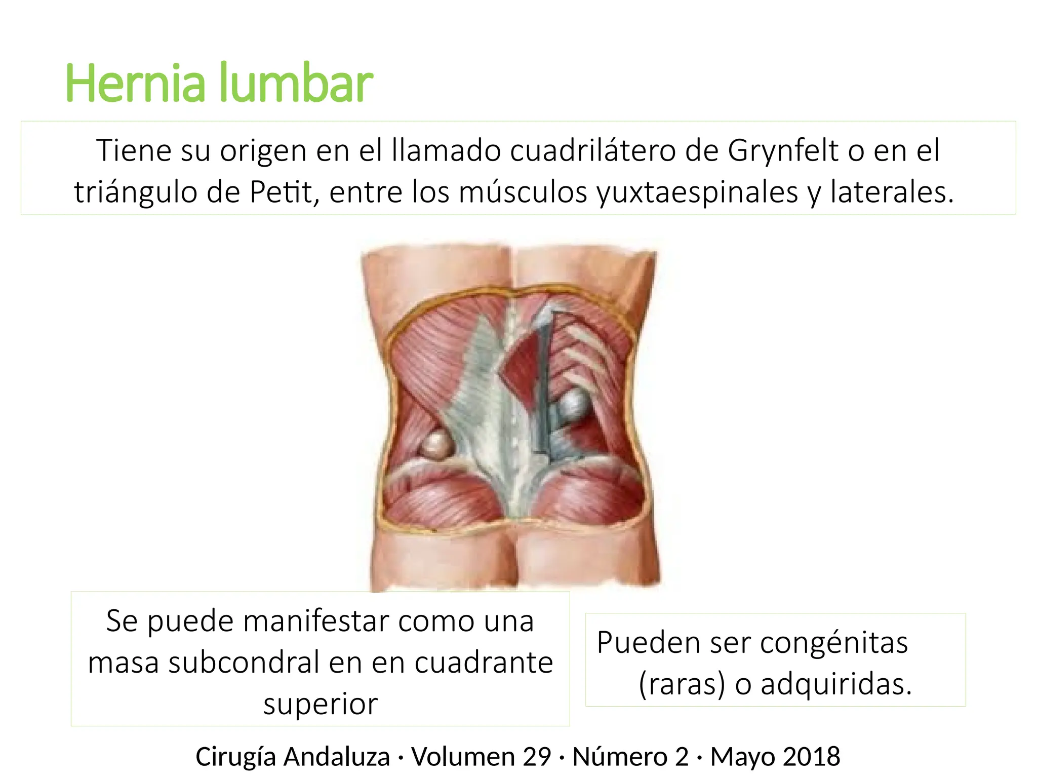 Hernia lumbar
Tiene su origen en el llamado cuadrilátero de Grynfelt o en el
triángulo de Petit, entre los músculos yuxtaespinales y laterales.
Cirugía Andaluza · Volumen 29 · Número 2 · Mayo 2018
Pueden ser congénitas
(raras) o adquiridas.
Se puede manifestar como una
masa subcondral en en cuadrante
superior
 