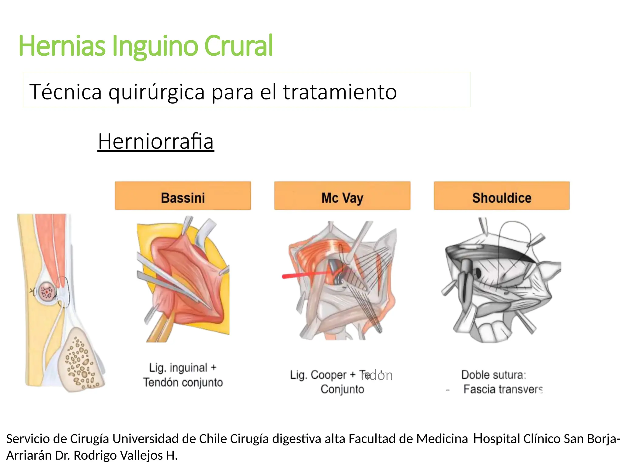 Hernias Inguino Crural
Técnica quirúrgica para el tratamiento
Herniorrafia
ndon
Servicio de Cirugía Universidad de Chile Cirugía digestiva alta Facultad de Medicina Hospital Clínico San Borja-
Arriarán Dr. Rodrigo Vallejos H.
 
