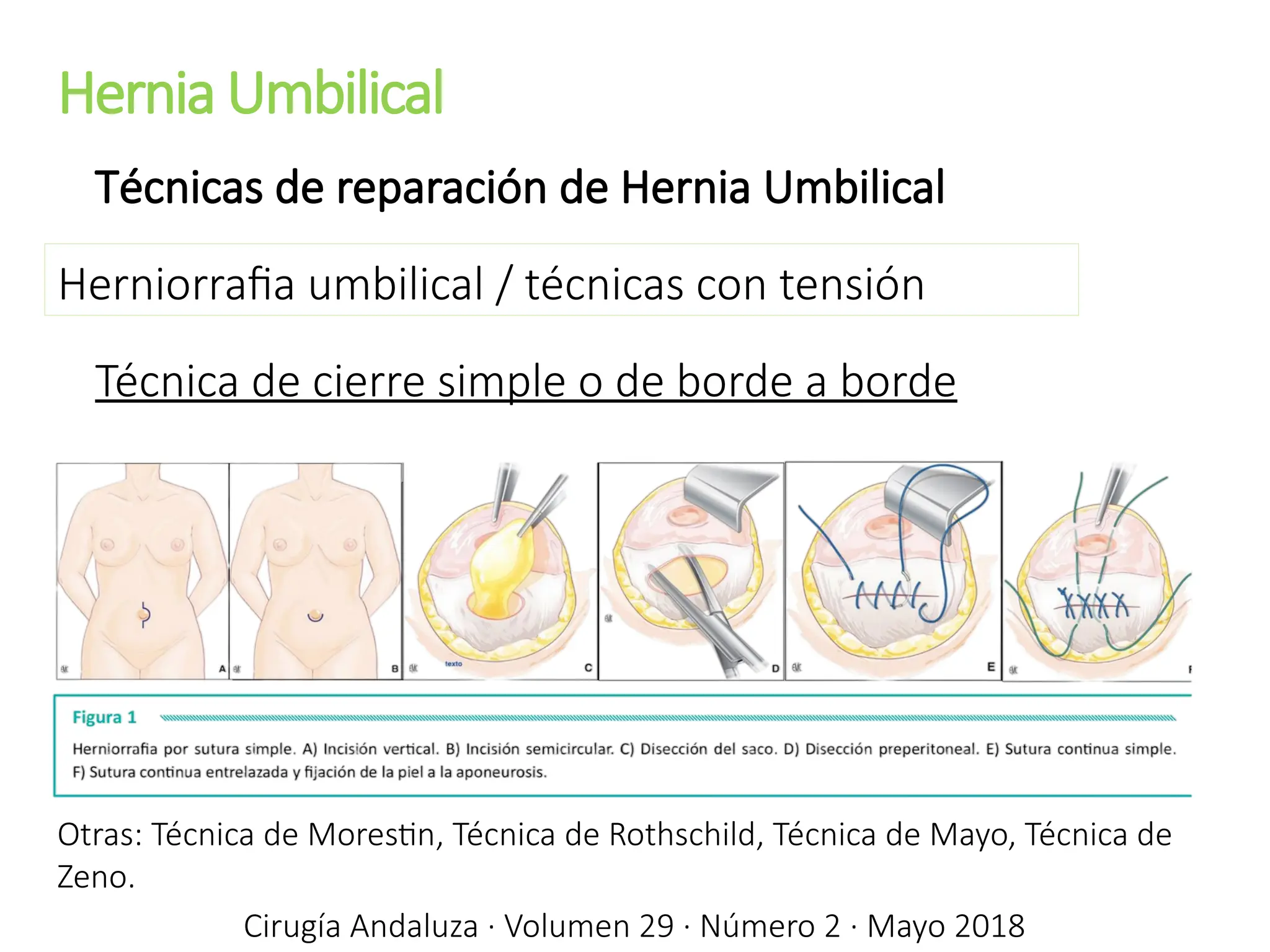 Hernia Umbilical
Cirugía Andaluza · Volumen 29 · Número 2 · Mayo 2018
Técnicas de reparación de Hernia Umbilical
Herniorrafia umbilical / técnicas con tensión
Técnica de cierre simple o de borde a borde
Otras: Técnica de Morestin, Técnica de Rothschild, Técnica de Mayo, Técnica de
Zeno.
 