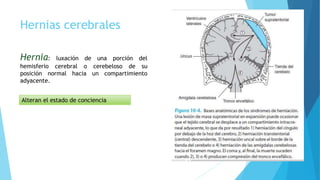 Hernias cerebrales
Hernia: luxación de una porción del
hemisferio cerebral o cerebeloso de su
posición normal hacia un compartimiento
adyacente.
Alteran el estado de conciencia
 