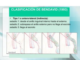 CLASIFICACIÓN DE BENDAVID (1993)
• Tipo 1 o antero-lateral (indirecta):
estadio 1: desde el anillo inguinal interno hasta ...