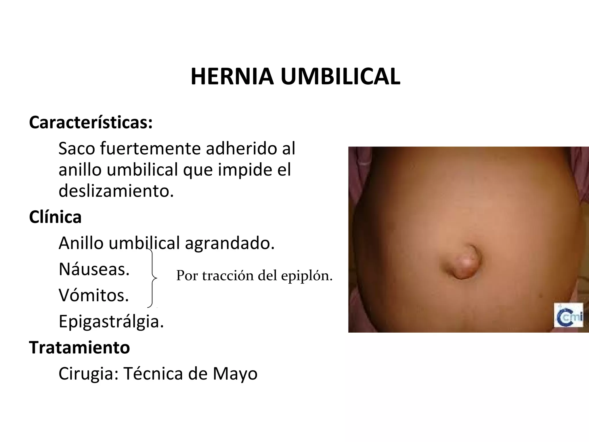 Hernias de la pared abdominal | PPT