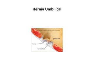 Hernias de la pared abdominal | PPT