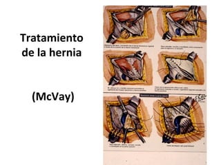 Mcvay Incision Hernias de la pared abdominal | PPT