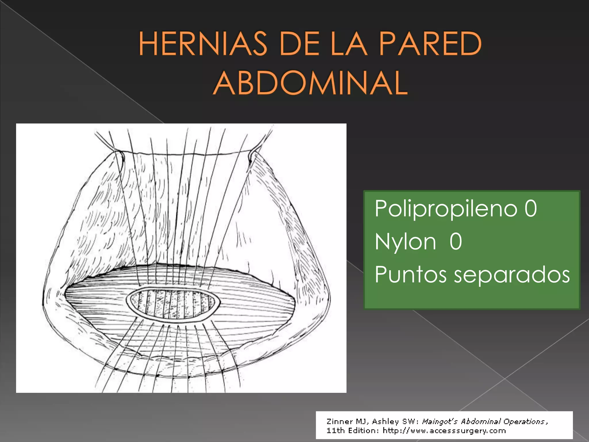 Hernias de la pared abdominal | PPT