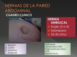 HERNIA
UMBILICAL
 Mujer (3 a 5)
 Sobrepeso
 35-50 años
SÍNTOMAS:
Asintomática 39%
Dolor al esfuerzo físico
61%
Abultamiento
1. Epiplón
2. Colón
3. Intestino
Delgado
CUADRO CLINICO
 