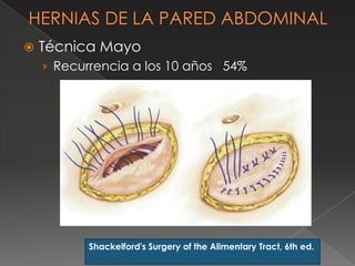  Técnica Mayo
› Recurrencia a los 10 años 54%
Shackelford's Surgery of the Alimentary Tract, 6th ed.
 