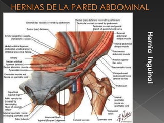 HerniaInguinal
 
