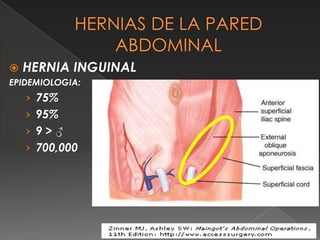  HERNIA INGUINAL
EPIDEMIOLOGIA:
› 75%
› 95%
› 9 > ♂
› 700,000
 