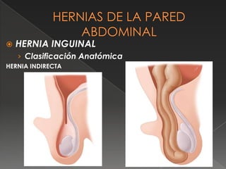  HERNIA INGUINAL
› Clasificación Anatómica
HERNIA INDIRECTA
 