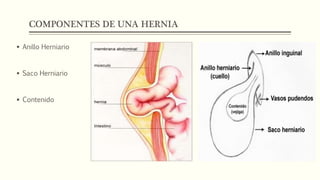 COMPONENTES DE UNA HERNIA
 Anillo Herniario
 Saco Herniario
 Contenido
 