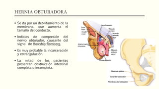 HERNIA OBTURADORA
 Se da por un debilitamiento de la
membrana, que aumenta el
tamaño del conducto.
 Indicios de compresión del
nervio obturador, causante del
signo de Howship-Romberg.
 Es muy probable la incarceración
y estrangulación.
 La mitad de los pacientes
presentan obstrucción intestinal
completa o incompleta.
 