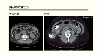 DIAGNÓSTICO
GRYNFELTT PETIT
 