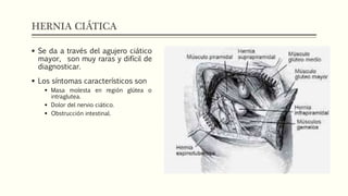HERNIA CIÁTICA
 Se da a través del agujero ciático
mayor, son muy raras y difícil de
diagnosticar.
 Los síntomas característicos son
 Masa molesta en región glútea o
intraglutea.
 Dolor del nervio ciático.
 Obstrucción intestinal.
 