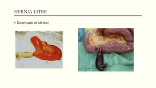 HERNIA LITRE
 Divertículo de Meckel
 