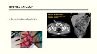 HERNIA AMYAND
 Su contenido es el apéndice
 