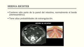 HERNIA RICHTER
 Contiene sólo parte de la pared del intestino, normalmente el borde
antimesentérico.
 Tiene altas probabilidades de estrangulación.
 