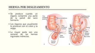 HERNIA POR DESLIZAMIENTO
 Se produce cuando un
órgano comprime una parte
de la pared del saco
herniario.
 Los órganos que usualmente
lo provocan son el colon y la
vejiga.
 La mayor parte son una
variante de las hernias
inguinales indirectas.
 