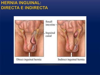 HERNIA INGUINAL:
DIRECTA E INDIRECTA
 