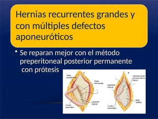Hernias recurrentes grandes y
con múltiples defectos
aponeuróticos
• Se reparan mejor con el método
preperitoneal posterior permanente
con prótesis
 