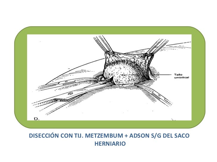 Hernias de la pared abdominal Hernias de la pared abdominal