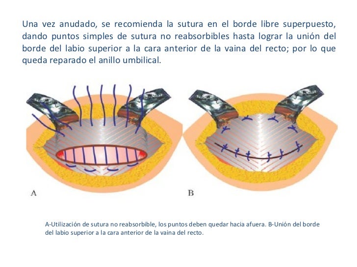 Hernias de la pared abdominal Hernias de la pared abdominal