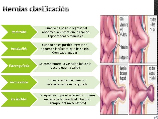Hernias De La Pared Abdominal hernias-de-la-pared-abdominal