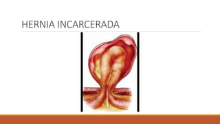 HERNIA INCARCERADA
 