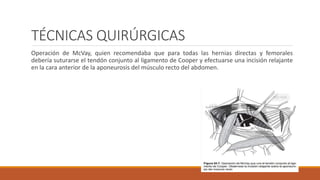 TÉCNICAS QUIRÚRGICAS
Operación de McVay, quien recomendaba que para todas las hernias directas y femorales
debería suturarse el tendón conjunto al ligamento de Cooper y efectuarse una incisión relajante
en la cara anterior de la aponeurosis del músculo recto del abdomen.
 