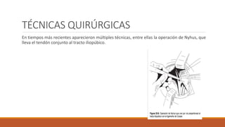 TÉCNICAS QUIRÚRGICAS
En tiempos más recientes aparecieron múltiples técnicas, entre ellas la operación de Nyhus, que
lleva el tendón conjunto al tracto iliopúbico.
 