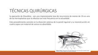 TÉCNICAS QUIRÚRGICAS
la operación de Shouldice, con una impresionante tasa de recurrencia de menos de 1% es una
de las hernioplastias que se efectúa con más frecuencia en la actualidad.
Este procedimiento consiste en la disección extensa de la pared inguinal y su reconstrucción en
cuatro capas con material de sutura no absorbible.
 
