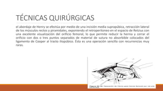 TÉCNICAS QUIRÚRGICAS
el abordaje de Henry se efectúa por medio de una incisión media suprapúbica, retracción lateral
de los músculos rectos y piramidales, exponiendo el retroperitoneo en el espacio de Retzius con
una excelente visualización del orificio femoral, lo que permite reducir la hernia y cerrar el
orificio con dos o tres puntos separados de material de sutura no absorbible colocados del
ligamento de Cooper al tracto iliopúbico. Ésta es una operación sencilla con recurrencias muy
raras.
 